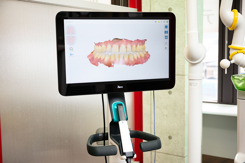 iTeroによるデジタルスキャンで、より快適な型取りを