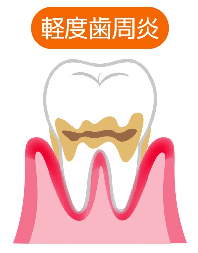 軽度歯周炎