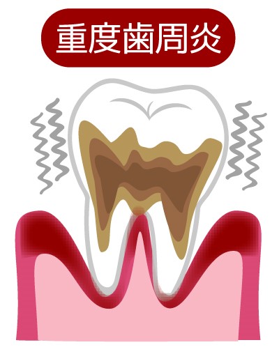 重度歯周炎